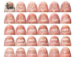 Gradual nail damage with a fungus