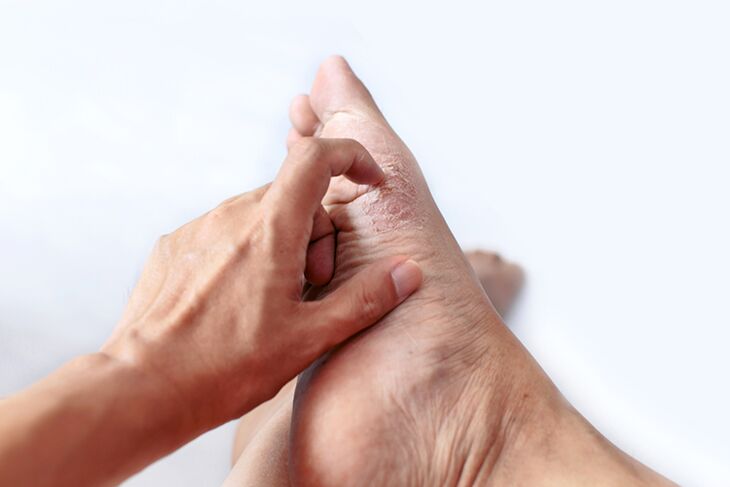 Epidermophytia