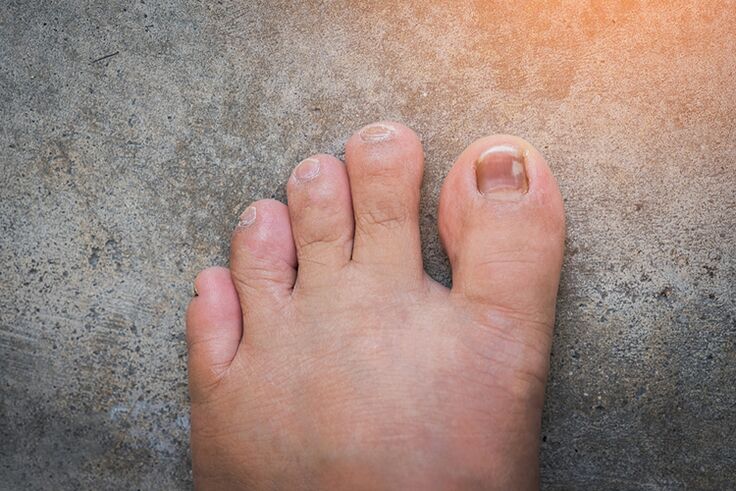 Nail mushroom