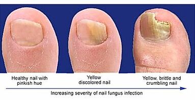 The demonstration of nail mushrooms