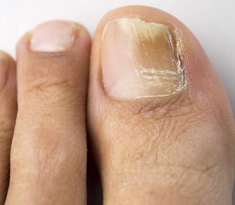 Chess treatment with iodine