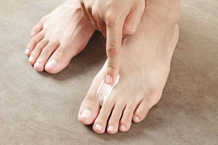 Application of antifungal cream to the skin of the foot