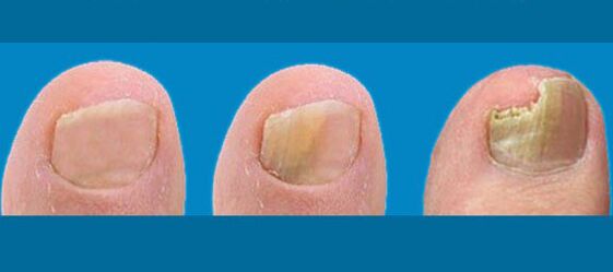 Nail fungus stages