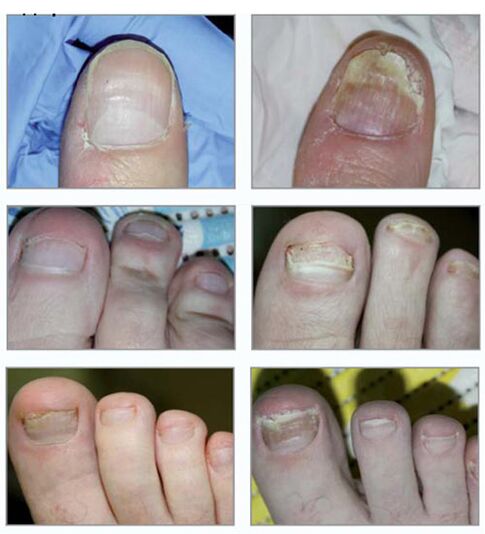 Types of nail mushrooms
