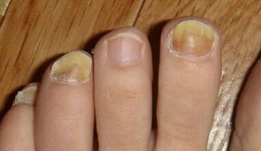 The causes of the mushroom appearance on the nails