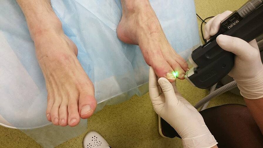 nail fungus laser treatment