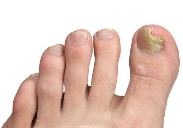 Causes of nail mushrooms