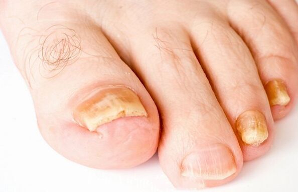 Nail mushrooms
