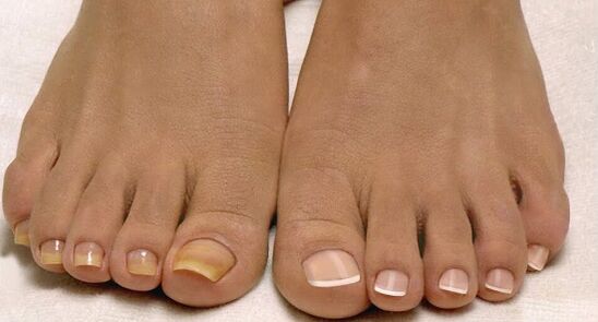 normal nails and toenail fungus