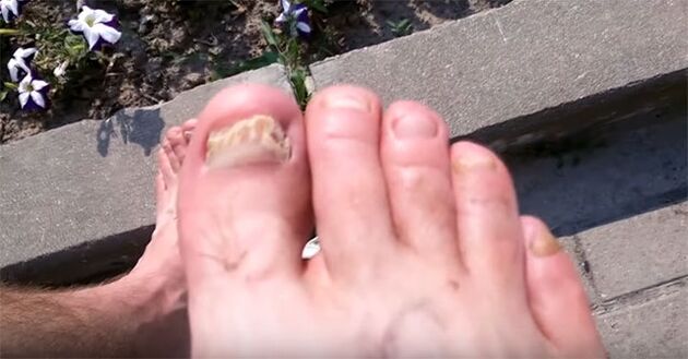 fungal nail