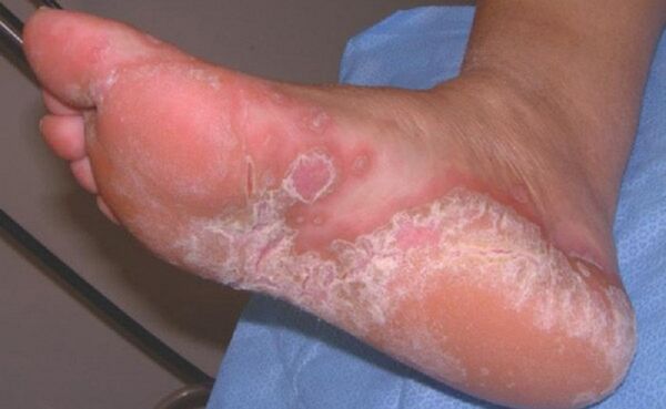 symptoms of yeast infection of the feet