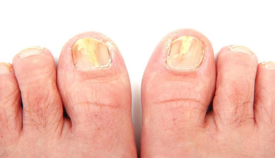 fungus on nails