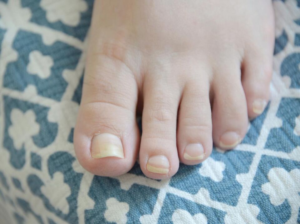 fungus on nails