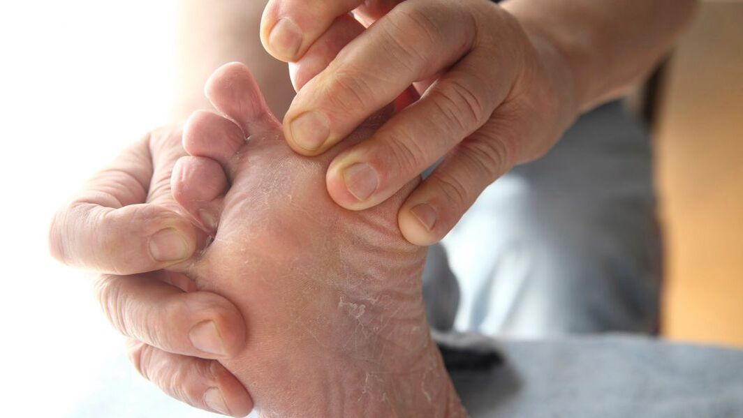 foot fungus symptoms