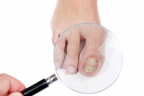 nail fungus