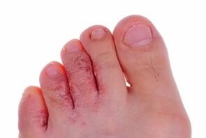 skin lesions due to fungus on the legs