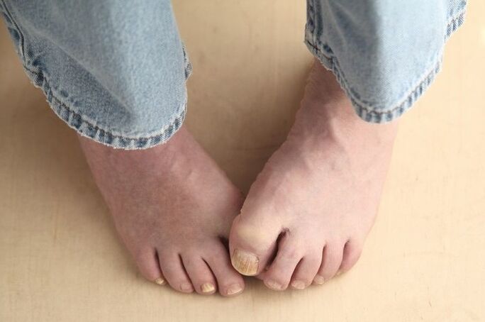 Feet with toenails affected by fungus