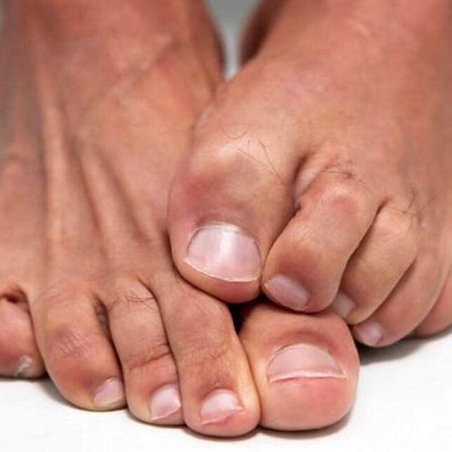 Fungus on the feet can be itchy