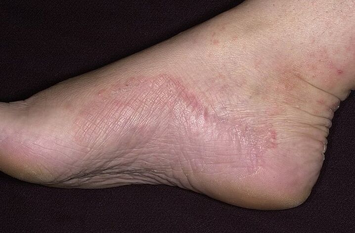 Fungal foot infection