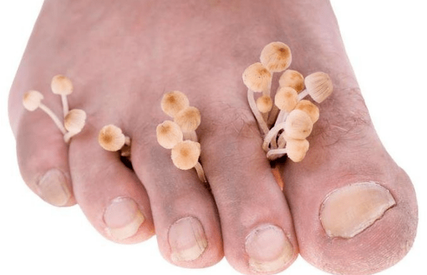 Fungal foot infection