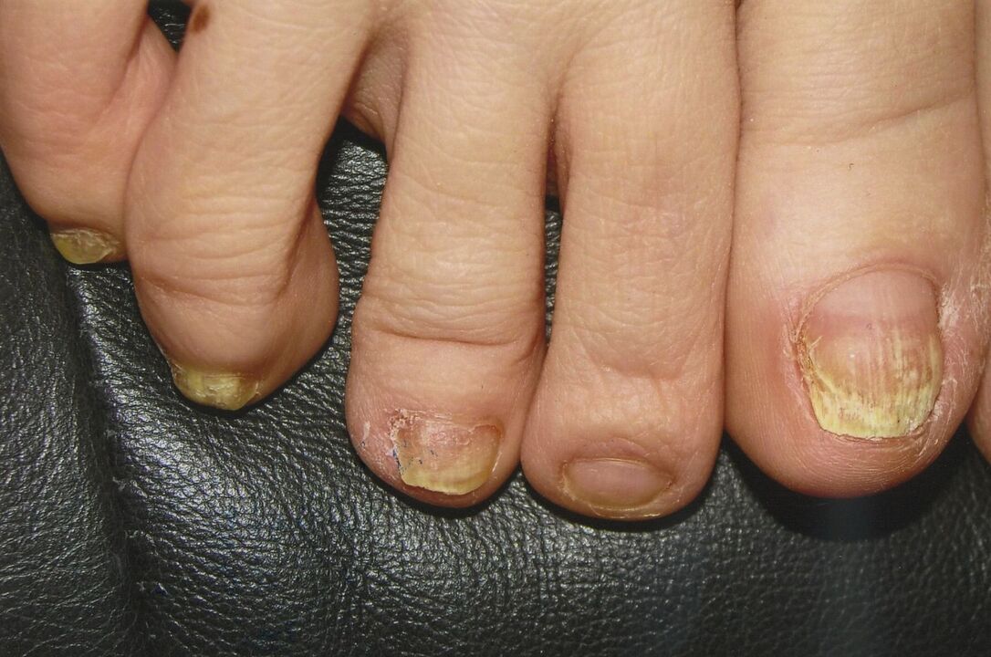 Fungus on the nails