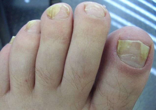 Nails affected by fungus