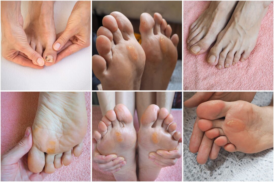 types of fungus on the feet